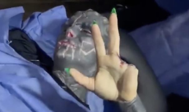 Man Gets His Fingers Surgically Removed So It Can Look Like A Claw, Wants To Look Like An Alien!