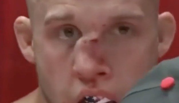 Tilted: MMA Fighter Nose Broke During A Match &amp; Know It's Leaning!