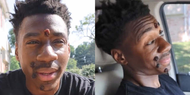 Y’all Play Too Much.. Buddy Details His First Day With The Pox!